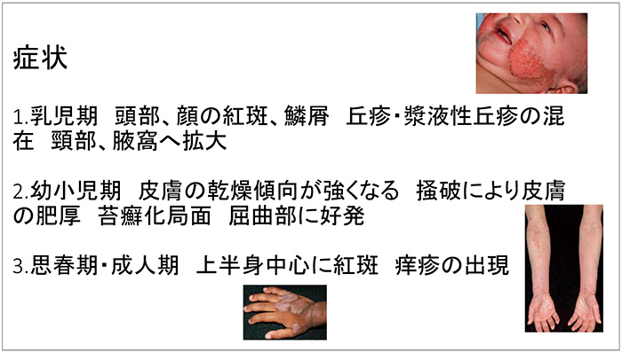 図3　アトピー性皮膚炎の症状<